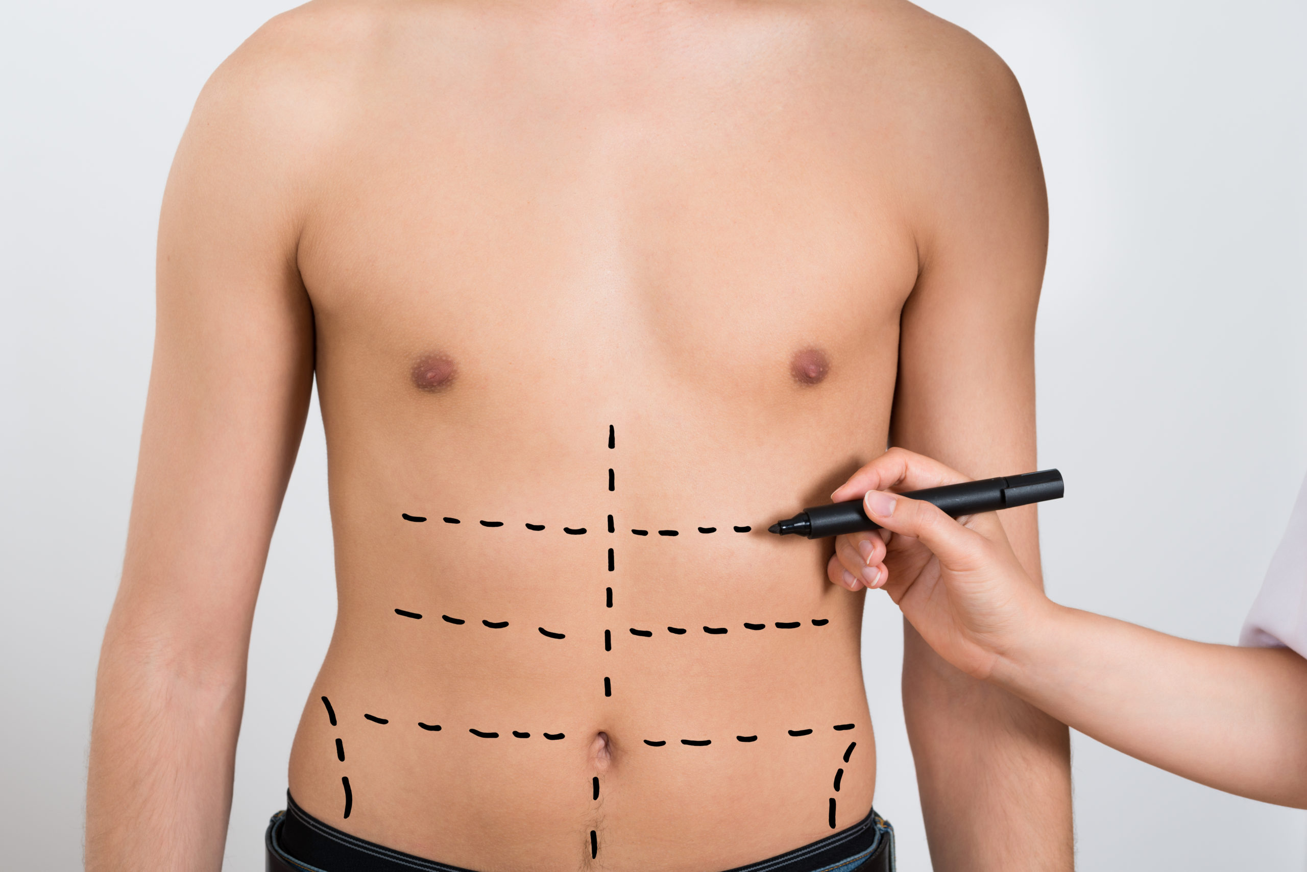 Abdominal Scar Removal with Tummy Tuck